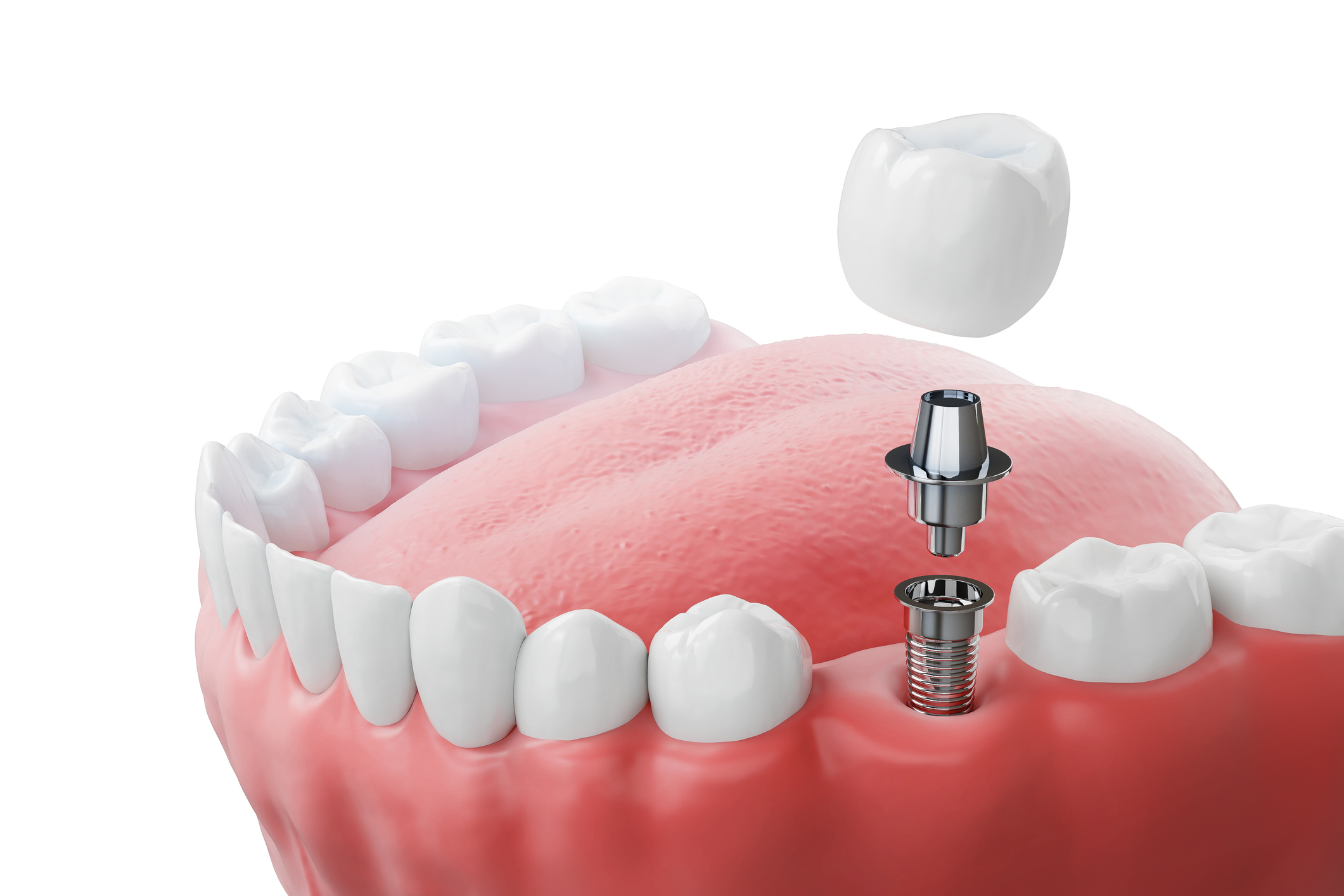 Dental İmplant